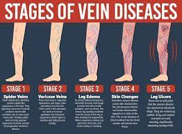 Can you reduce varicose vein?