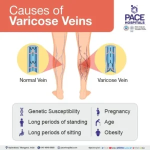 What are the main causes of varicose veins?